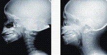 Good price Hoge de Röntgenstraal Kenmerkende Weergave van de Inktdekking, 35 x 43cm Laser Medische x ray Film online